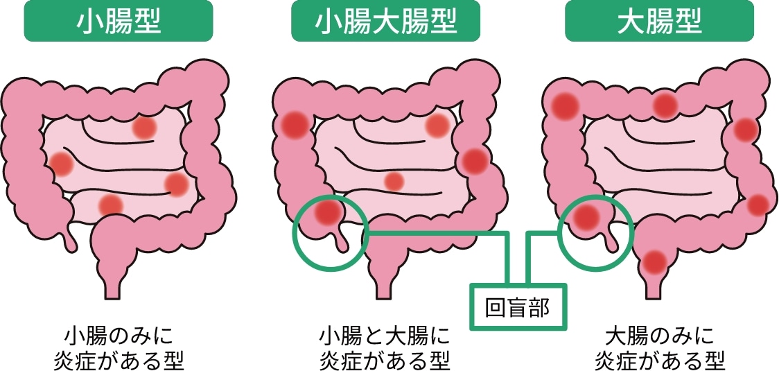 クローン病の病型には小腸型、小腸大腸型、大腸型の３つがあります。