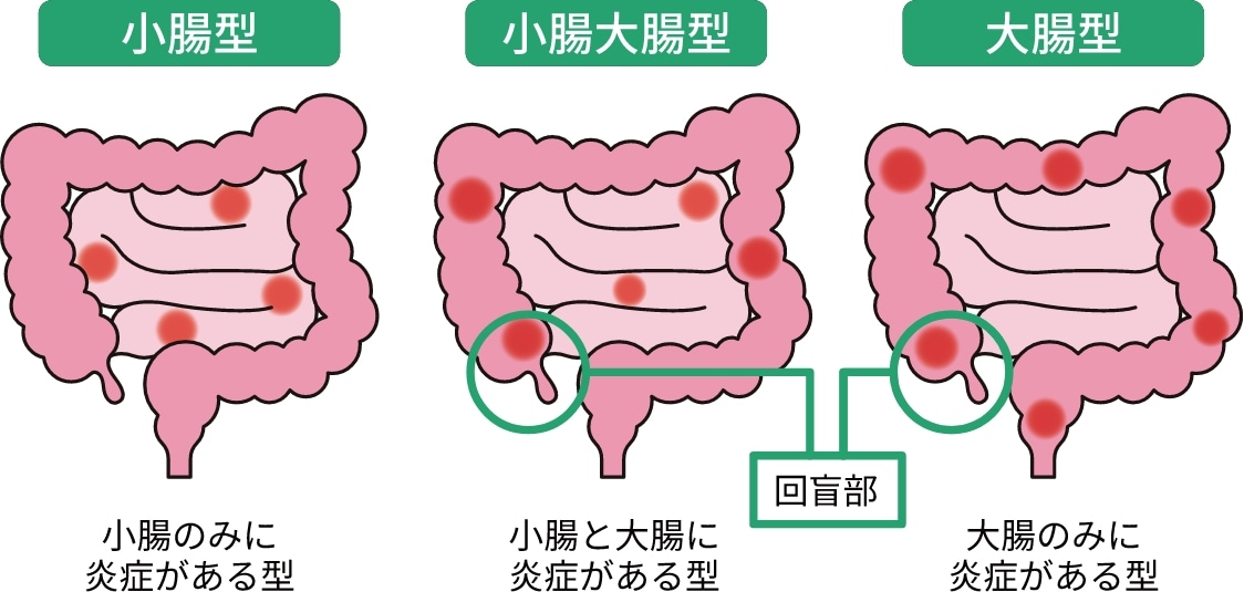 クローン回腸炎患者の今後の見通しはどうなりますか?