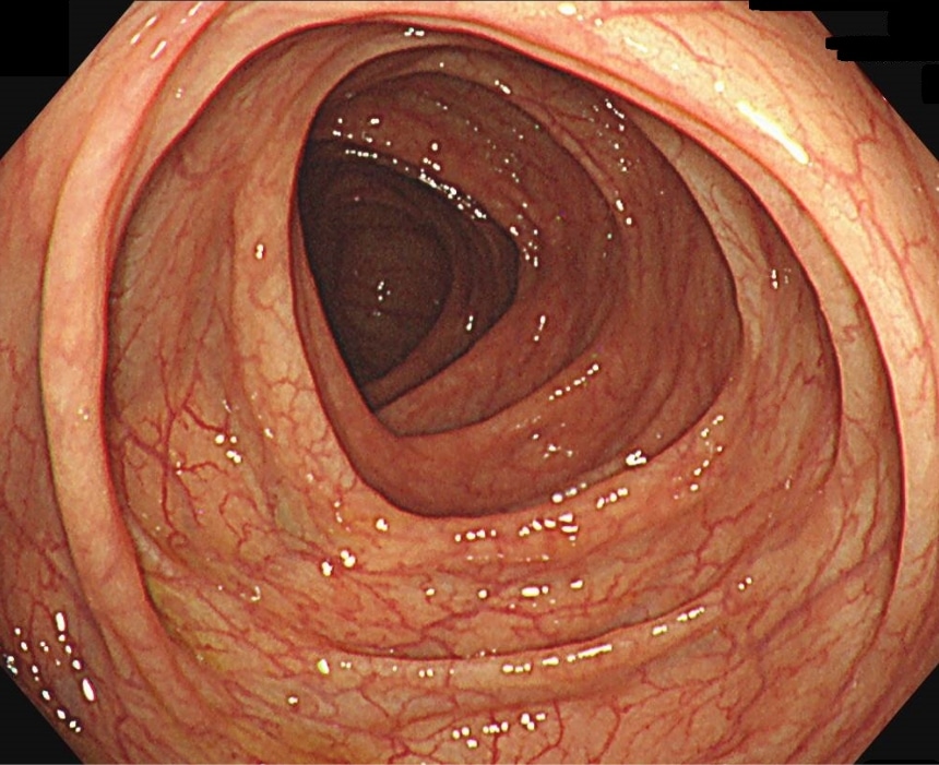 正常な腸の粘膜