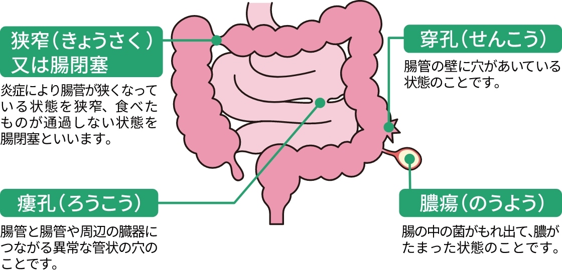 腸管合併症には狭窄、穿孔、瘻孔、肛門部病変などがあります。